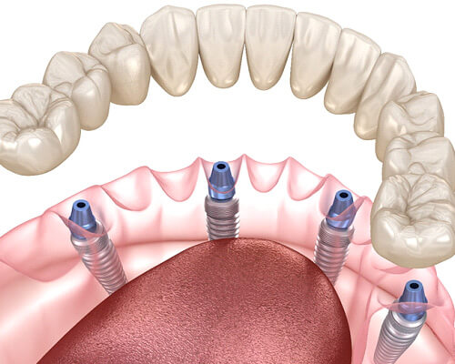 digital illustration of all-on4 dental implants