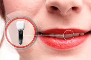 close-up of a woman smiling with a dental implant crown