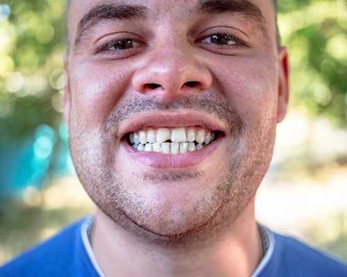 a man with a chipped tooth