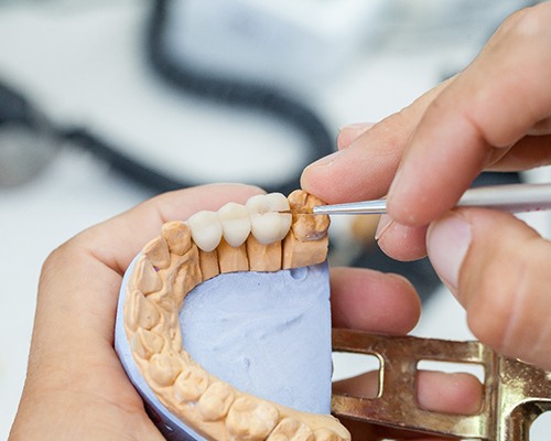 dental bridge being crafted