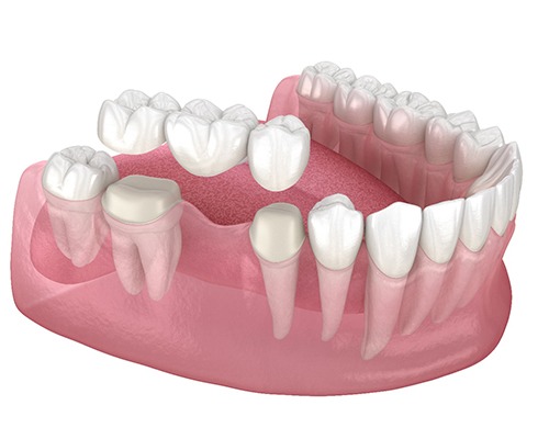 3D model of a dental bridge