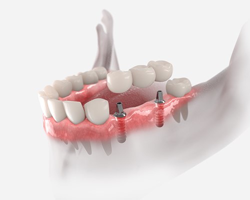3D render of an implant bridge