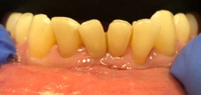 Misaligned bottom teeth