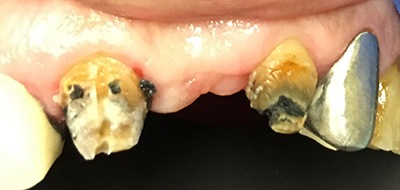 Missing and severely decayed top teeth