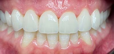 Gorgeous smile after cosmetic dentistry