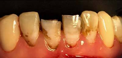 Severely decayed teeth