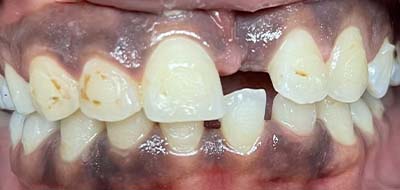 Severely damaged tooth