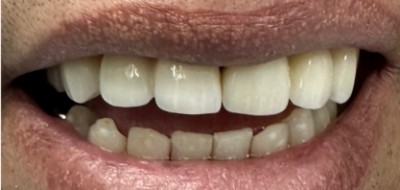 Closeup of flawlessly repaired smile