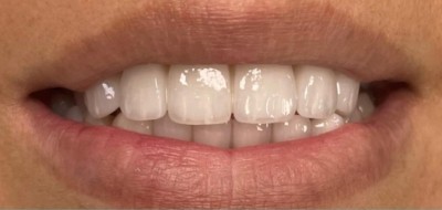 Closeup of flawlessly repaired smile