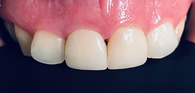 Perfected smile after restorative dentistry