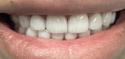 Closeup of flawlessly repaired smile