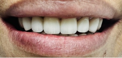 Closeup of flawlessly repaired smile