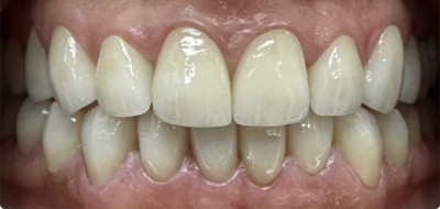 Closeup of flawlessly repaired smile