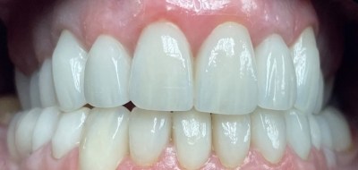 Closeup of flawlessly repaired smile