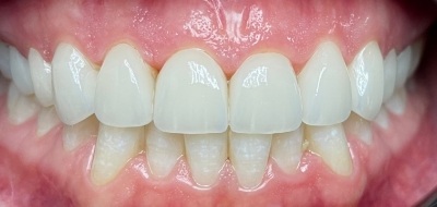 Closeup of flawlessly repaired smile