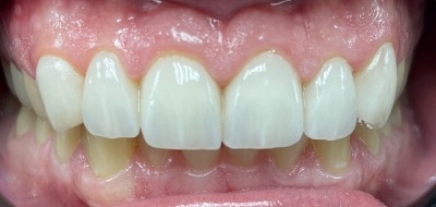 Closeup of flawlessly repaired smile