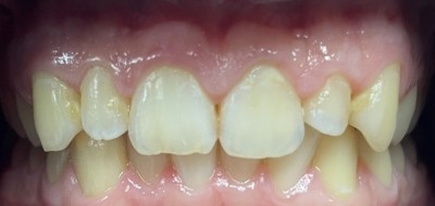 Closeup of worn and damaged teeth