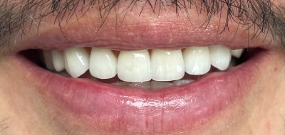 Closeup of flawlessly repaired smile