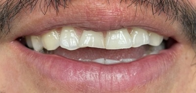 Closeup of worn and damaged teeth