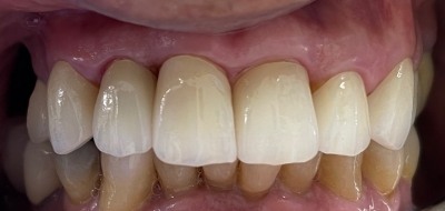 Closeup of flawlessly repaired smile