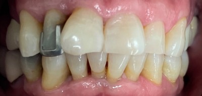 Closeup of worn and damaged teeth