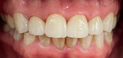 Closeup of flawlessly repaired smile