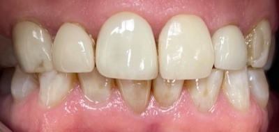 Closeup of worn and damaged teeth