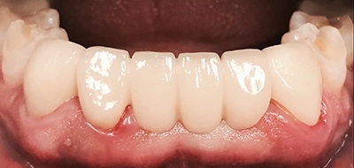 Closeup of flawlessly repaired smile