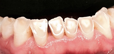 Closeup of worn and damaged teeth