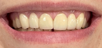 Closeup of flawlessly repaired smile