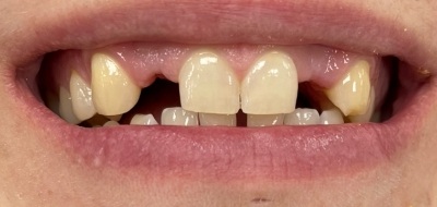 Closeup of worn and damaged teeth