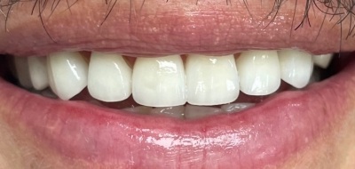 Closeup of flawlessly repaired smile