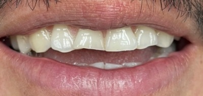 Closeup of worn and damaged teeth