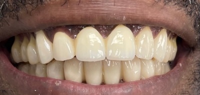 Closeup of flawlessly repaired smile