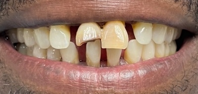 Closeup of worn and damaged teeth