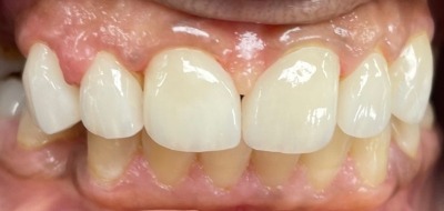 Closeup of flawlessly repaired smile