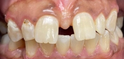 Closeup of worn and damaged teeth