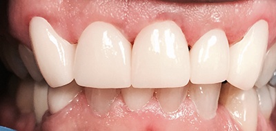 Gorgeous smile after cosmetic dentistry