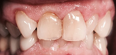 Worn and decayed smile before cosmetic dentistry