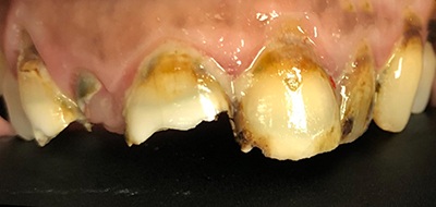 Severely decayed teeth