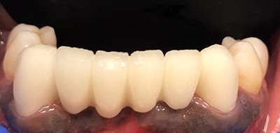 Gorgeous smile after restorative dentistry