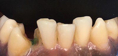 Severely damaged tooth