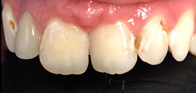 Discolroed and decayed top teeth