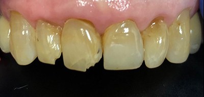 Yellowed and stained teeth