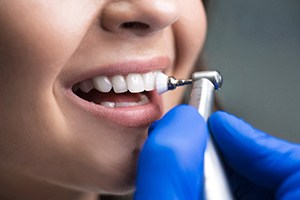 close up of a dental cleaning with a dentist in Bedford