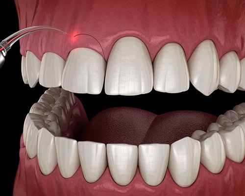 Animated gum recontouring treatment