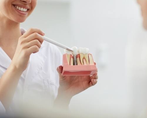 Model of dental implant supported dental crown