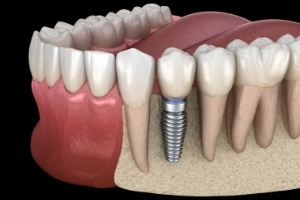 Animated smile with dental implant supported dental crown