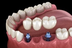 Animated smile with dental implant supported dental bridge