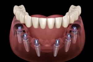 Animated dental implant supported denture